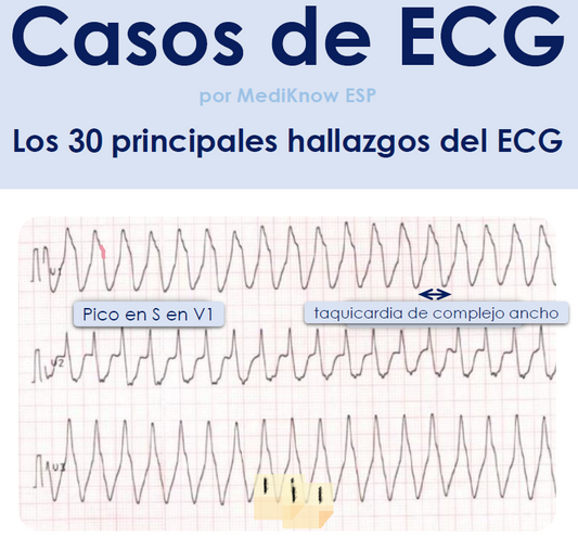 Casos de ECG